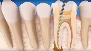Endodontia - Tratamento de Canal