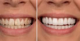 Facetas Dentárias