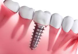 Implantes Dentários